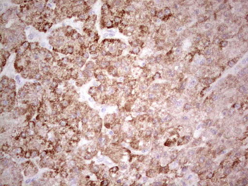 SUOX / Sulfite Oxidase Antibody - Immunohistochemical staining of paraffin-embedded Carcinoma of Human liver tissue using anti-SUOX mouse monoclonal antibody. (Heat-induced epitope retrieval by 1 mM EDTA in 10mM Tris, pH8.5, 120C for 3min,