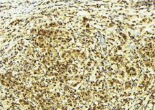 SUPT4H1 / SPT4 Antibody - 1:100 staining human breast carcinoma tissue by IHC-P. The sample was formaldehyde fixed and a heat mediated antigen retrieval step in citrate buffer was performed. The sample was then blocked and incubated with the antibody for 1.5 hours at 22°C. An HRP conjugated goat anti-rabbit antibody was used as the secondary.