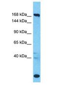 SUPT6H / SPT6 Antibody - SUPT6H / SPT6 antibody Western Blot of Colorectal Tumor. Antibody dilution: 1 ug/ml.  This image was taken for the unconjugated form of this product. Other forms have not been tested.