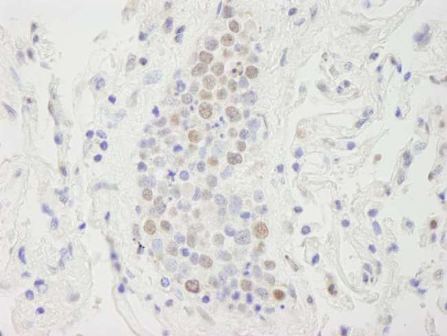 SUPT6H / SPT6 Antibody - Detection of Human SUPT6H by Immunohistochemistry. Sample: FFPE section of human small cell lung cancer. Antibody: Affinity purified rabbit anti-SUPT6H used at a dilution of 1:500.
