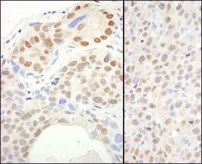 SUPT6H / SPT6 Antibody - Detection of Human and Mouse SUPT6H by Immunohistochemistry. Sample: FFPE sections of human breast carcinoma (left) and mouse squamous cell carcinoma (right). Antibody: Affinity purified rabbit anti-SUPT6H used at a dilution of 1:1000 (0.2 ug/ml). Detection: DAB.