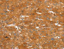 SUR2 / ABCC9 Antibody - Immunohistochemistry of paraffin-embedded Human esophagus cancer using ABCC9 Polyclonal Antibody at dilution of 1:50.