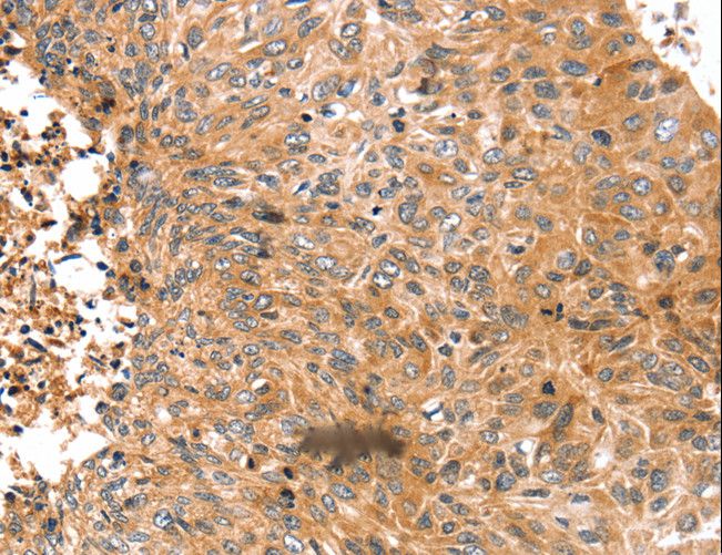 SUR2 / ABCC9 Antibody - Immunohistochemistry of paraffin-embedded Human esophagus cancer using ABCC9 Polyclonal Antibody at dilution of 1:50.