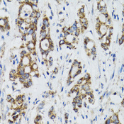 SURF1 Antibody - Immunohistochemistry of paraffin-embedded human colon carcinoma tissue.