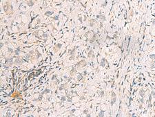 SUSD3 Antibody - Immunohistochemistry of paraffin-embedded Human liver cancer tissue  using SUSD3 Polyclonal Antibody at dilution of 1:95(×200)