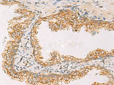 SUSD3 Antibody - Immunohistochemistry of paraffin-embedded Human prost at e cancer tissue  using SUSD3 Polyclonal Antibody at dilution of 1:85(×200)