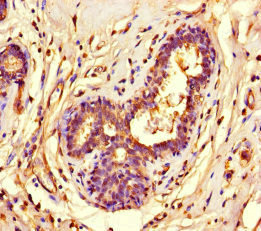SUV39H1 Antibody - Immunohistochemistry of paraffin-embedded human breast cancer at dilution of 1:100
