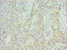 SUV39H2 Antibody - Immunohistochemistry of paraffin-embedded human breast cancer using antibody at 1:100 dilution.
