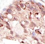 SUV39H2 Antibody - Formalin-fixed and paraffin-embedded human cancer tissue reacted with the primary antibody, which was peroxidase-conjugated to the secondary antibody, followed by DAB staining. This data demonstrates the use of this antibody for immunohistochemistry; clinical relevance has not been evaluated. BC = breast carcinoma; HC = hepatocarcinoma.