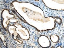 SUV39H2 Antibody - Immunohistochemistry of paraffin-embedded Human prost at e cancer tissue  using SUV39H2 Polyclonal Antibody at dilution of 1:70(×200)