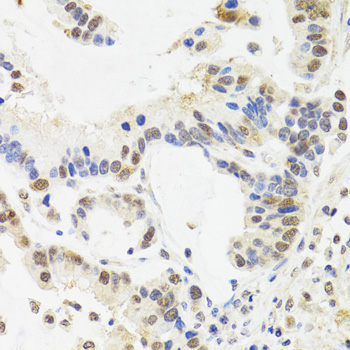 SUZ12 Antibody - Immunohistochemistry of paraffin-embedded human gastric cancer tissue.