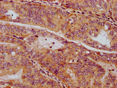 SV2C Antibody - Immunohistochemistry Dilution at 1:300 and staining in paraffin-embedded human endometrial cancer performed on a Leica BondTM system. After dewaxing and hydration, antigen retrieval was mediated by high pressure in a citrate buffer (pH 6.0). Section was blocked with 10% normal Goat serum 30min at RT. Then primary antibody (1% BSA) was incubated at 4°C overnight. The primary is detected by a biotinylated Secondary antibody and visualized using an HRP conjugated SP system.