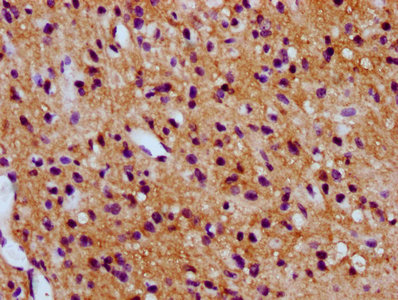 SV2C Antibody - Immunohistochemistry Dilution at 1:300 and staining in paraffin-embedded human glioma cancer performed on a Leica BondTM system. After dewaxing and hydration, antigen retrieval was mediated by high pressure in a citrate buffer (pH 6.0). Section was blocked with 10% normal Goat serum 30min at RT. Then primary antibody (1% BSA) was incubated at 4°C overnight. The primary is detected by a biotinylated Secondary antibody and visualized using an HRP conjugated SP system.