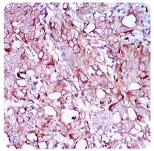 SYCP3 / SCP3 Antibody - Immunohistochemistry: SCP3 Antibody (6F9C5) - IHC analysis of paraffin-embedded human cervical cancer tissues with DAB staining.  This image was taken for the unconjugated form of this product. Other forms have not been tested.