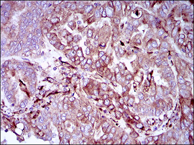 SYCP3 / SCP3 Antibody - IHC of paraffin-embedded endometrial cancer tissues using SYCP3 mouse monoclonal antibody with DAB staining.