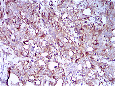 SYCP3 / SCP3 Antibody - IHC of paraffin-embedded cervical cancer tissues using SYCP3 mouse monoclonal antibody with DAB staining.