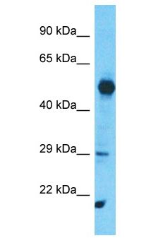 SYCP3 / SCP3 Antibody - SYCP3 / SCP3 antibody Western Blot of Esophagus Tumor. Antibody dilution: 1 ug/ml.  This image was taken for the unconjugated form of this product. Other forms have not been tested.