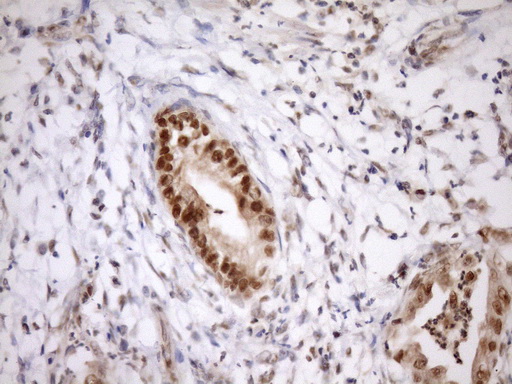 SYF2 / p29 Antibody - IHC of paraffin-embedded Carcinoma of Human pancreas tissue using anti-SYF2 mouse monoclonal antibody. (Heat-induced epitope retrieval by Tris-EDTA, pH8.0)(1:150).