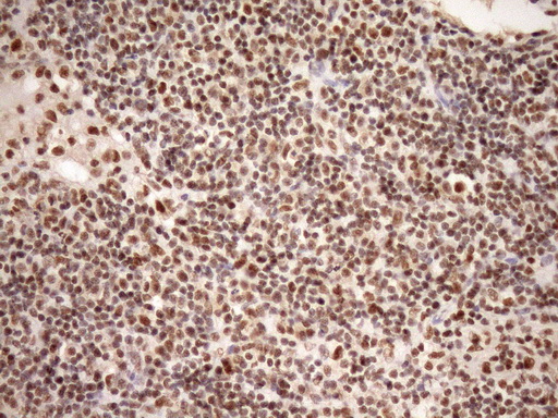 SYF2 / p29 Antibody - IHC of paraffin-embedded Carcinoma of Human bladder tissue using anti-SYF2 mouse monoclonal antibody. (Heat-induced epitope retrieval by Tris-EDTA, pH8.0)(1:150).