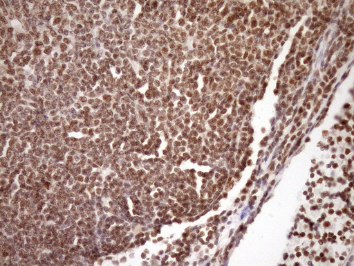 SYF2 / p29 Antibody - IHC of paraffin-embedded Human lymphoma tissue using anti-SYF2 mouse monoclonal antibody. (Heat-induced epitope retrieval by Tris-EDTA, pH8.0)(1:150).