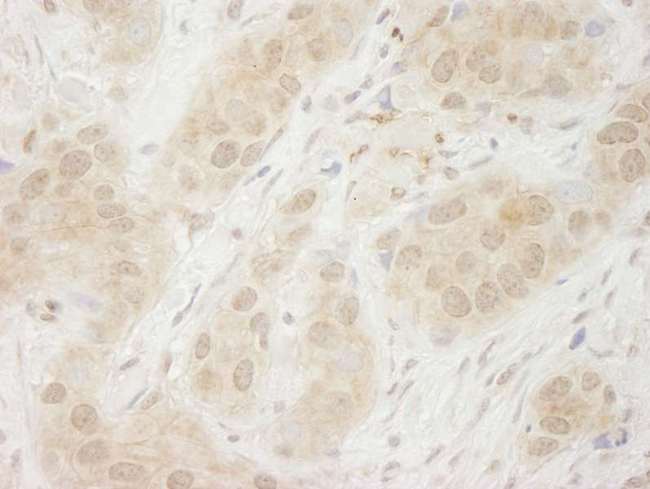 SYK Antibody - Detection of Human SYK by Immunohistochemistry. Sample: FFPE section of human breast carcinoma. Antibody: Affinity purified rabbit anti-SYK used at a dilution of 1:250.