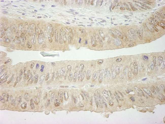 SYK Antibody - Detection of Human SYK by Immunohistochemistry. Sample: FFPE section of human colon carcinoma. Antibody: Affinity purified rabbit anti-SYK used at a dilution of 1:250.
