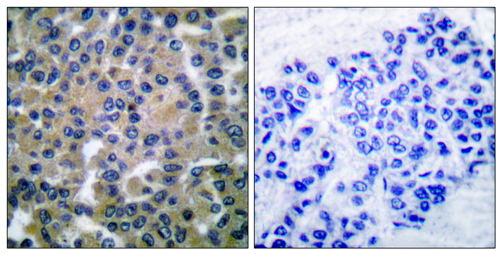 SYK Antibody - Immunohistochemistry analysis of paraffin-embedded human breast carcinoma tissue, using SYK Antibody. The picture on the right is blocked with the synthesized peptide.