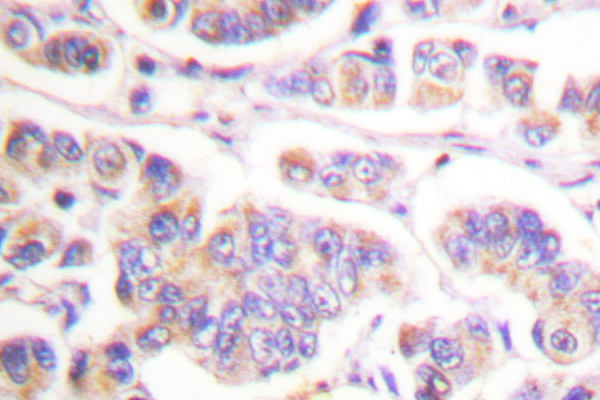 SYK Antibody - IHC of SYK (L519) pAb in paraffin-embedded human breast carcinoma tissue.
