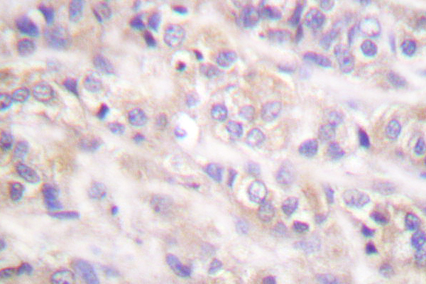 SYK Antibody - IHC of SYK (F169) pAb in paraffin-embedded human prostate carcinoma tissue.