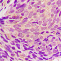 SYK Antibody - Immunohistochemical analysis of SYK (pY323) staining in human breast cancer formalin fixed paraffin embedded tissue section. The section was pre-treated using heat mediated antigen retrieval with sodium citrate buffer (pH 6.0). The section was then incubated with the antibody at room temperature and detected using an HRP conjugated compact polymer system. DAB was used as the chromogen. The section was then counterstained with hematoxylin and mounted with DPX.