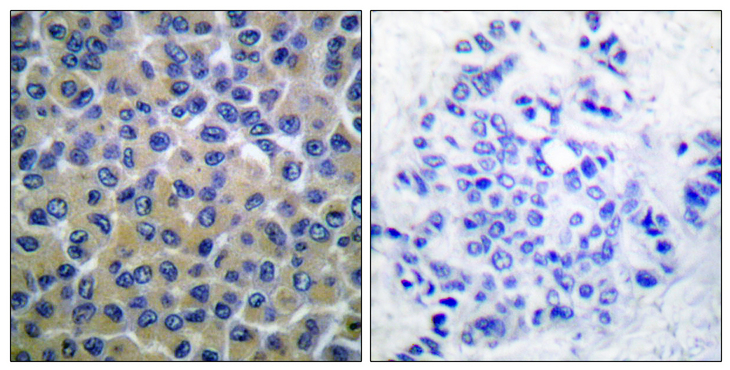 SYK Antibody - Immunohistochemistry analysis of paraffin-embedded human breast carcinoma, using SYK (Phospho-Tyr348) Antibody. The picture on the right is blocked with the phospho peptide.