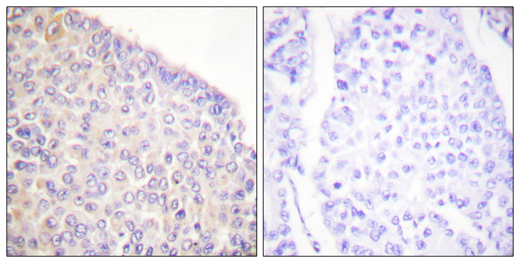 SYK Antibody - Immunohistochemistry analysis of paraffin-embedded human breast carcinoma, using SYK (Phospho-Tyr525) Antibody. The picture on the right is blocked with the phospho peptide.