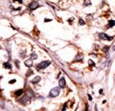 SYK Antibody - Formalin-fixed and paraffin-embedded human cancer tissue reacted with the primary antibody, which was peroxidase-conjugated to the secondary antibody, followed by AEC staining. This data demonstrates the use of this antibody for immunohistochemistry; clinical relevance has not been evaluated. BC = breast carcinoma; HC = hepatocarcinoma.
