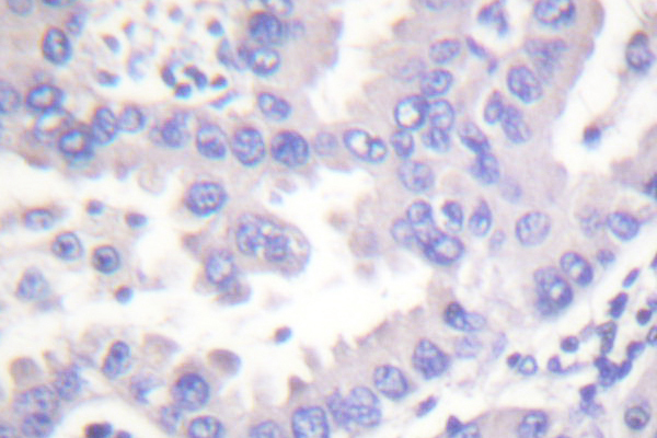 SYK Antibody - IHC of SYK (P342) pAb in paraffin-embedded human breast carcinoma tissue.