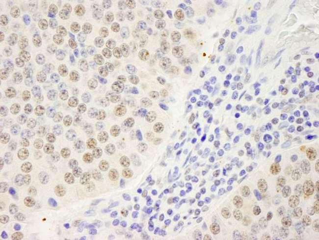 SYMPK / Symplekin Antibody - Detection of Human Symplekin Immunohistochemistry. Sample: FFPE section of human pancreatic islet cell tumor. Antibody: Affinity purified rabbit anti-Symplekin used at a dilution of 1:250.