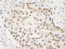 SYMPK / Symplekin Antibody - Detection of Human Symplekin by Immunohistochemistry. Sample: FFPE section of human breast carcinoma. Antibody: Affinity purified rabbit anti-Symplekin used at a dilution of 1:200 (1 ug/ml). Detection: DAB.