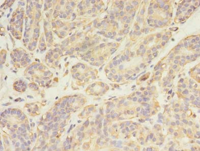 SYN / FYN Antibody - Immunohistochemistry of paraffin-embedded human breast cancer using antibody at dilution of 1:100.