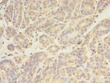 SYN / FYN Antibody - Immunohistochemistry of paraffin-embedded human breast cancer using antibody at dilution of 1:100.