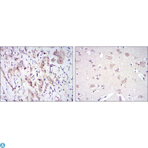 SYN / FYN Antibody - Immunohistochemistry (IHC) analysis of paraffin-embedded breast cancer tissues (left) and brain tissues (right) with DAB staining using Fyn Monoclonal Antibody.