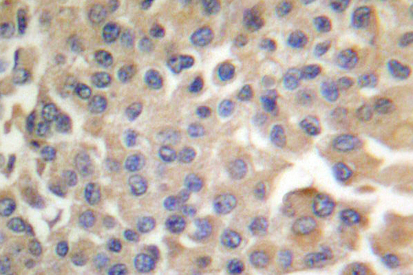 SYN / FYN Antibody - IHC of p-Fyn (Y530) pAb in paraffin-embedded human breast carcinoma tissue.