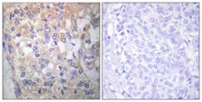 SYN / FYN Antibody - Immunohistochemistry analysis of paraffin-embedded human breast carcinoma, using Fyn (Phospho-Tyr530) Antibody. The picture on the right is blocked with the phospho peptide.