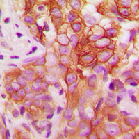 SYN / FYN Antibody - Immunohistochemical analysis of FYN (pY530) staining in human breast cancer formalin fixed paraffin embedded tissue section. The section was pre-treated using heat mediated antigen retrieval with sodium citrate buffer (pH 6.0). The section was then incubated with the antibody at room temperature and detected using an HRP conjugated compact polymer system. DAB was used as the chromogen. The section was then counterstained with hematoxylin and mounted with DPX.
