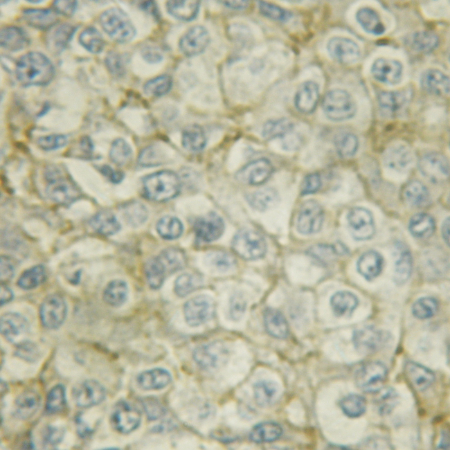 SYN / FYN Antibody - 1/100 staining human liver cancer tissue by IHC-P. The sample was formaldehyde fixed and a heat mediated antigen retrieval step in citrate buffer was performed. The sample was then blocked and incubated with the antibody for 1.5 hours at 22°C. An HRP conjugated goat anti-rabbit antibody was used as the secondary antibody.