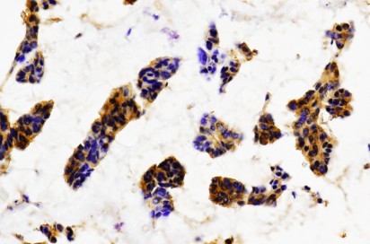 SYN / FYN Antibody - IHC of Fyn pAb in paraffin-embedded human breast carcinoma tissue.