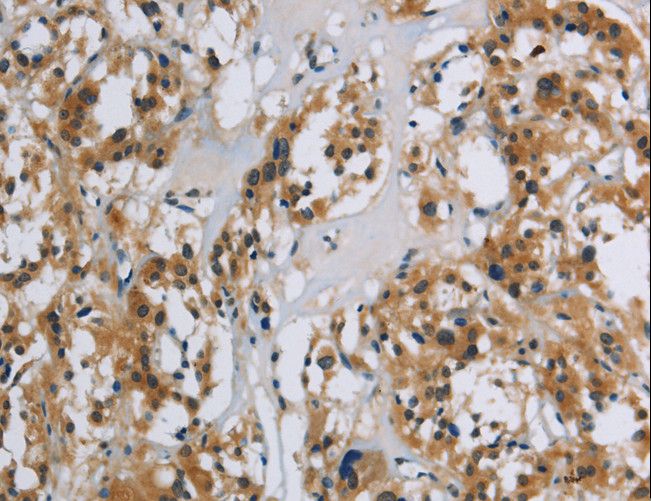 SYN1 / Synapsin 1 Antibody - Immunohistochemistry of paraffin-embedded Human thyroid cancer using SYN1 Polyclonal Antibody at dilution of 1:40.