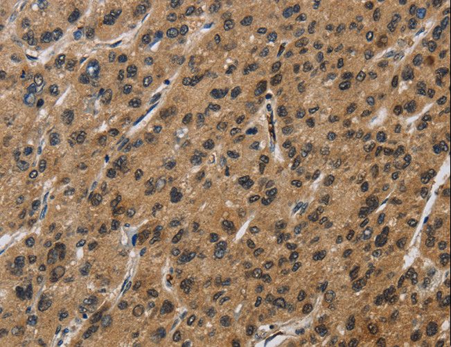 SYN1 / Synapsin 1 Antibody - Immunohistochemistry of paraffin-embedded Human liver cancer using SYN1 Polyclonal Antibody at dilution of 1:50.