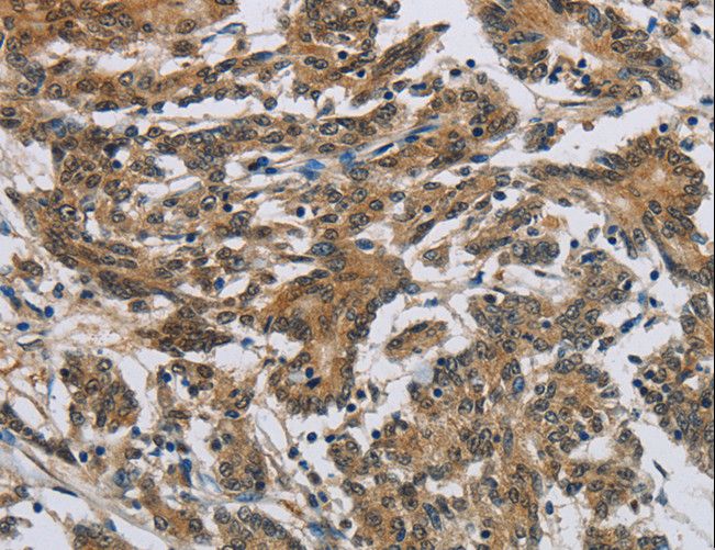 SYN1 / Synapsin 1 Antibody - Immunohistochemistry of paraffin-embedded Human colon cancer using SYN1 Polyclonal Antibody at dilution of 1:50.