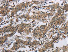 SYN2 / Synapsin II Antibody - Immunohistochemistry of paraffin-embedded Human gastric cancer using SYN2 Polyclonal Antibody at dilution of 1:40.