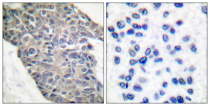 Synaptotagmin Antibody - Immunohistochemistry analysis of paraffin-embedded human breast carcinoma tissue, using Synaptotagmin Antibody. The picture on the right is blocked with the synthesized peptide.
