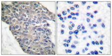 Synaptotagmin Antibody - Immunohistochemistry analysis of paraffin-embedded human breast carcinoma tissue, using Synaptotagmin Antibody. The picture on the right is blocked with the synthesized peptide.